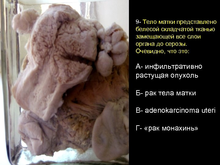 9 - Тело матки представлено белесой складчатой тканью замещающей все слои органа до серозы.
