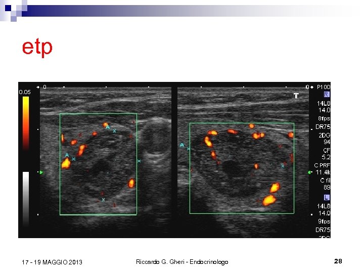 etp 17 - 19 MAGGIO 2013 Riccardo G. Gheri - Endocrinologo 28 