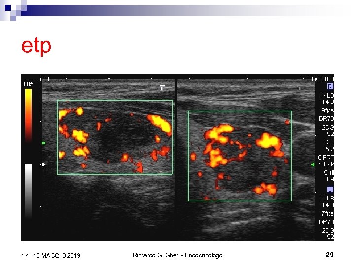 etp 17 - 19 MAGGIO 2013 Riccardo G. Gheri - Endocrinologo 29 