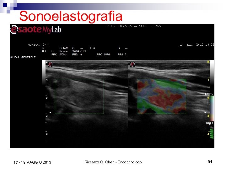 Sonoelastografia 17 - 19 MAGGIO 2013 Riccardo G. Gheri - Endocrinologo 31 