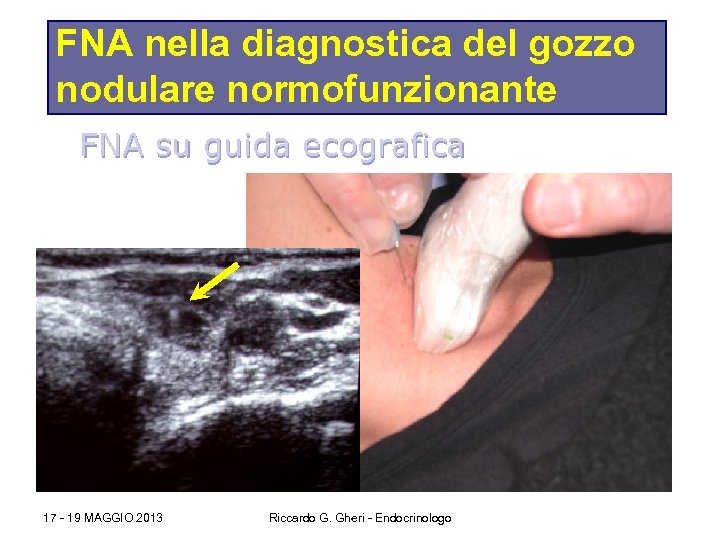 FNA nella diagnostica del gozzo nodulare normofunzionante FNA su guida ecografica 17 - 19
