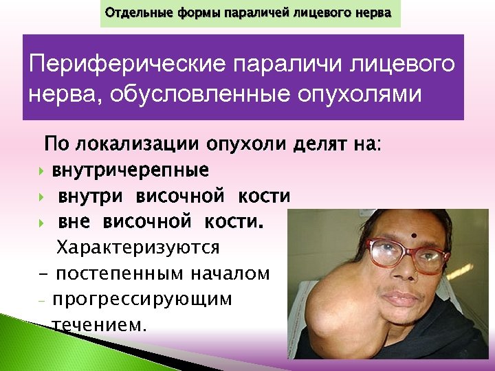 Отдельные формы параличей лицевого нерва Периферические параличи лицевого нерва, обусловленные опухолями По локализации опухоли