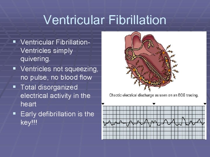 Ventricular Fibrillation § Ventricular Fibrillation. Ventricles simply quivering. § Ventricles not squeezing, no pulse,