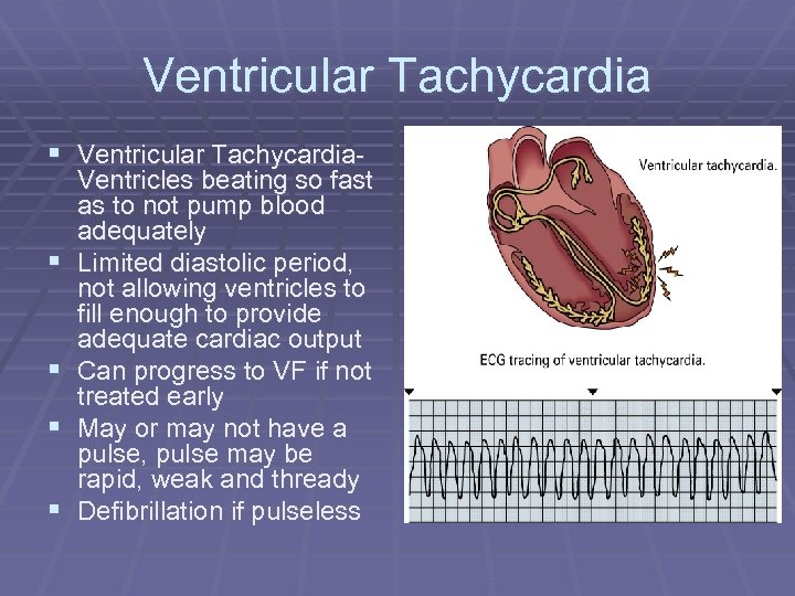 Ventricular Tachycardia § Ventricular Tachycardia§ § Ventricles beating so fast as to not pump