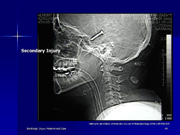 Secondary Injury Used with permission of American Journal of Roentgenology 2006; 187: 609 -616