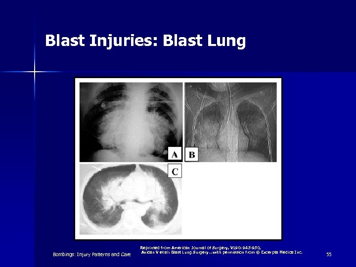 Blast Injuries: Blast Lung Bombings: Injury Patterns and Care Reprinted from American Journal of