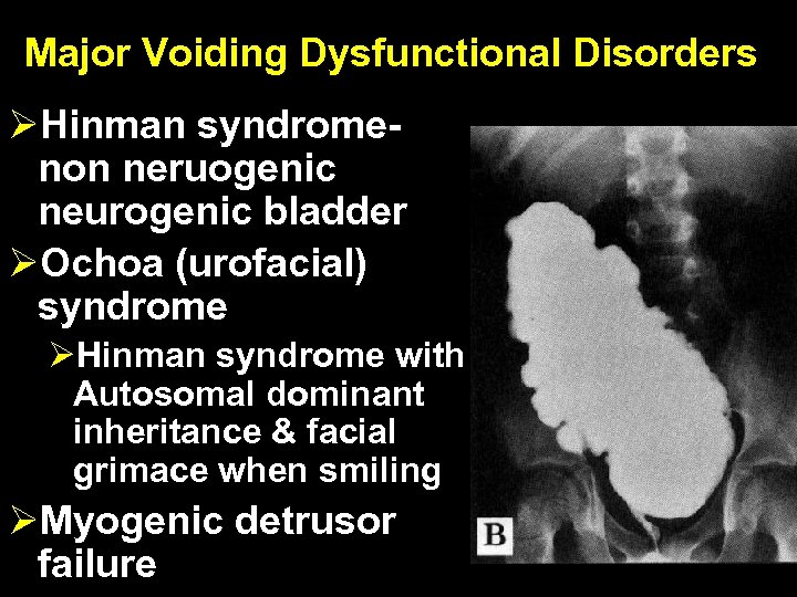 Major Voiding Dysfunctional Disorders ØHinman syndromenon neruogenic neurogenic bladder ØOchoa (urofacial) syndrome ØHinman syndrome