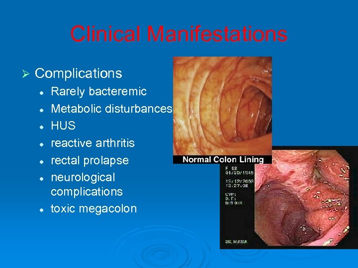 Clinical Manifestations Ø Complications l l l l Rarely bacteremic Metabolic disturbances HUS reactive