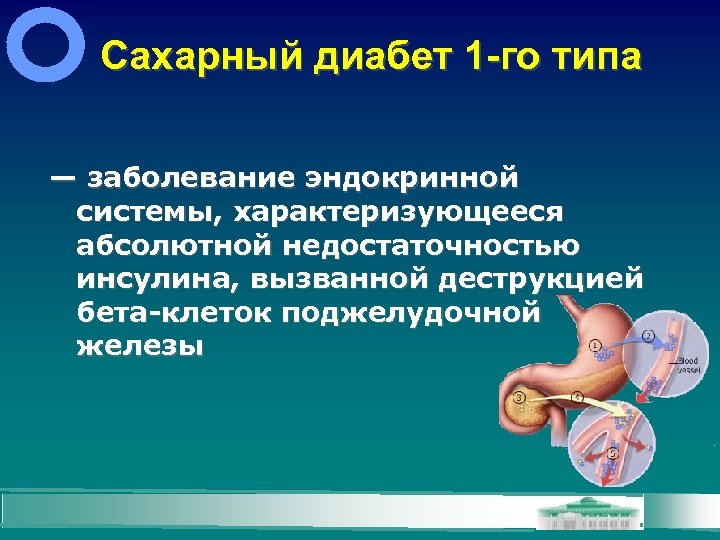 Сахарный диабет 1 -го типа — заболевание эндокринной системы, характеризующееся абсолютной недостаточностью инсулина, вызванной