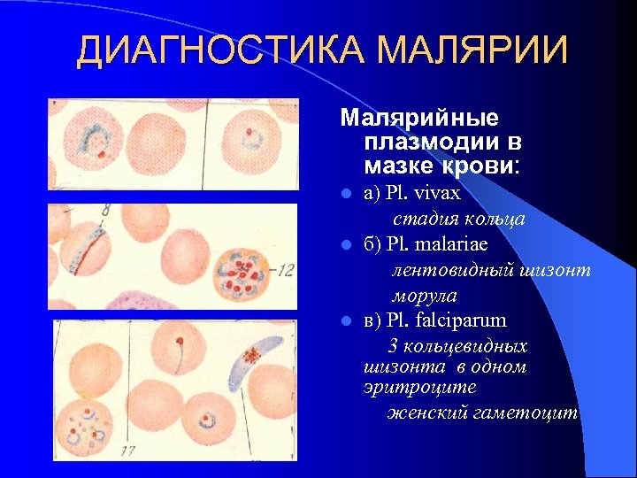 ДИАГНОСТИКА МАЛЯРИИ Малярийные плазмодии в мазке крови: а) Pl. vivax стадия кольца l б)