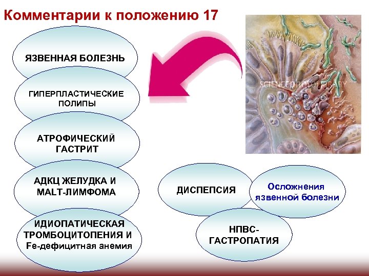 Комментарии к положению 17 ЯЗВЕННАЯ БОЛЕЗНЬ ГИПЕРПЛАСТИЧЕСКИЕ ПОЛИПЫ АТРОФИЧЕСКИЙ ГАСТРИТ АДКЦ ЖЕЛУДКА И MALT-ЛИМФОМА