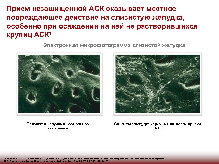 Прием незащищенной АСК оказывает местное повреждающее действие на слизистую желудка, особенно при осаждении на