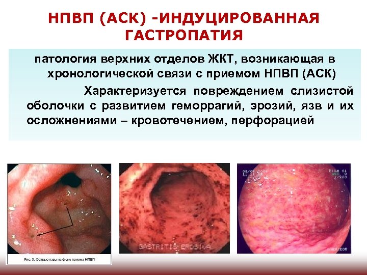 НПВП (АСК) -ИНДУЦИРОВАННАЯ ГАСТРОПАТИЯ патология верхних отделов ЖКТ, возникающая в хронологической связи с приемом