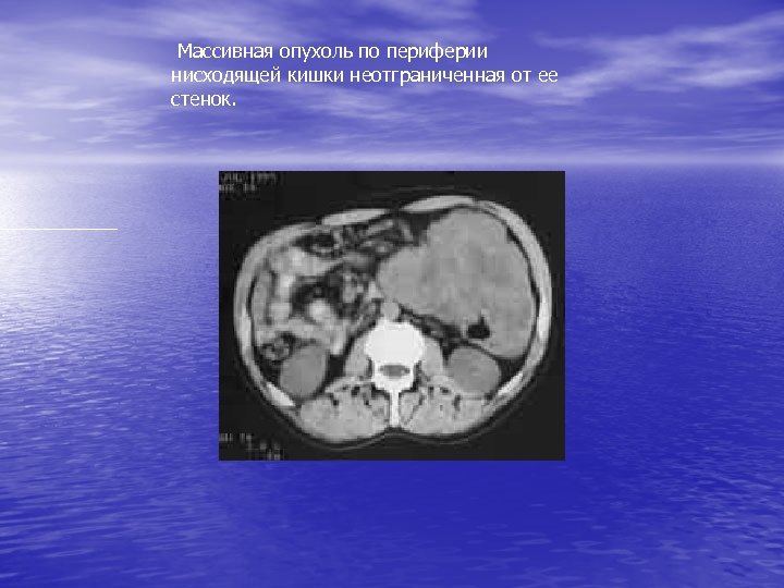 Массивная опухоль по периферии нисходящей кишки неотграниченная от ее стенок. 