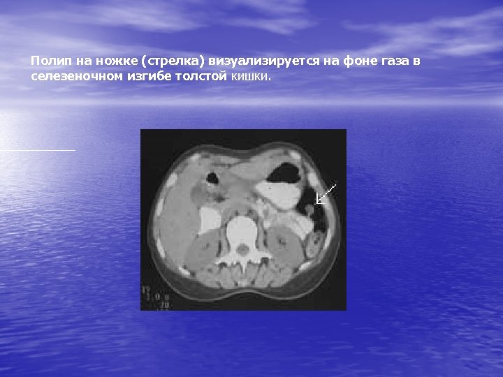 Полип на ножке (стрелка) визуализируется на фоне газа в селезеночном изгибе толстой кишки. 
