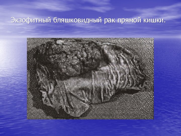 Экзофитный бляшковидный рак прямой кишки. 