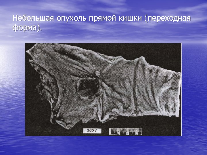 Небольшая опухоль прямой кишки (переходная форма). 