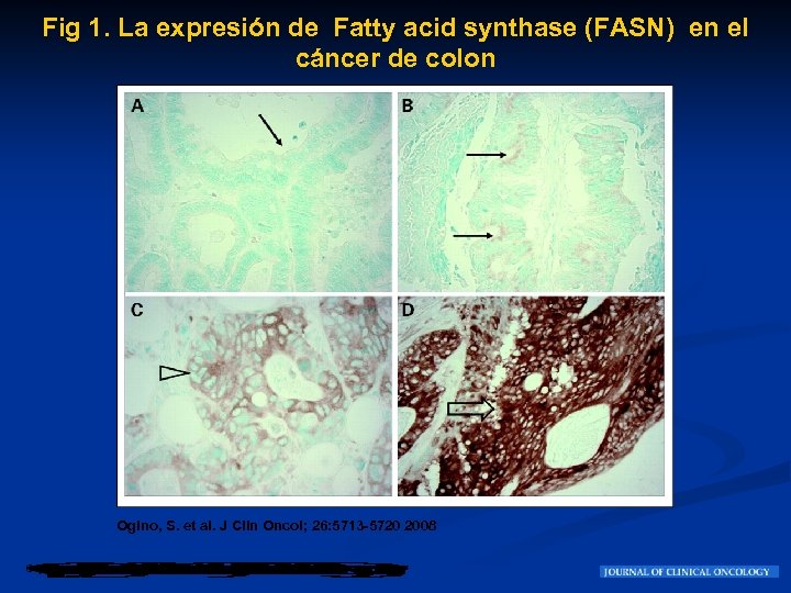 Fig 1. La expresión de Fatty acid synthase (FASN) en el cáncer de colon