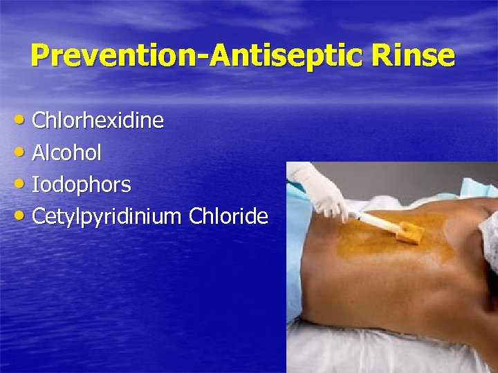 Prevention-Antiseptic Rinse • Chlorhexidine • Alcohol • Iodophors • Cetylpyridinium Chloride 