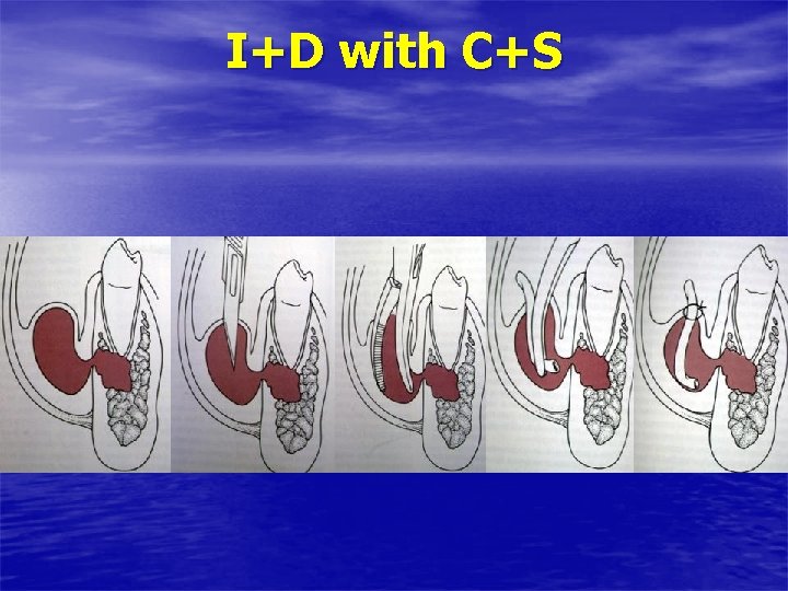 I+D with C+S 