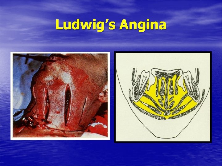 Ludwig’s Angina 
