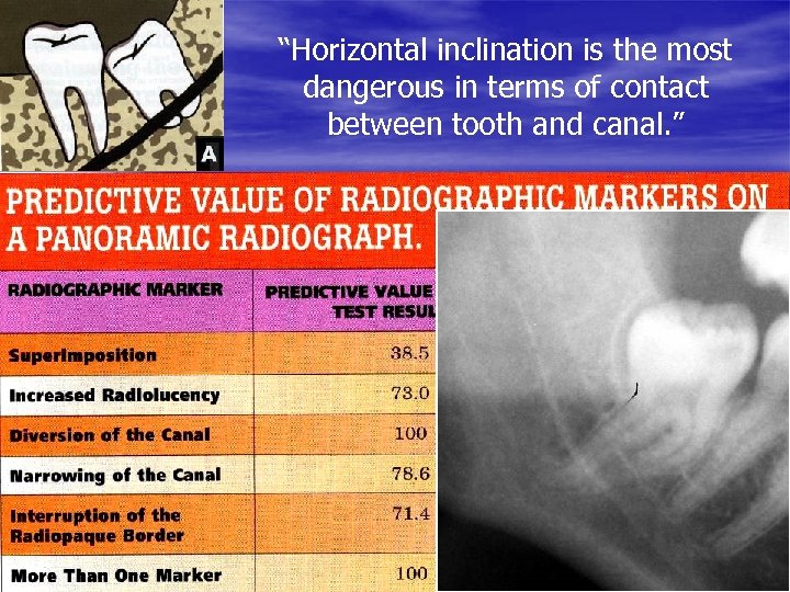 “Horizontal inclination is the most dangerous in terms of contact between tooth and canal.