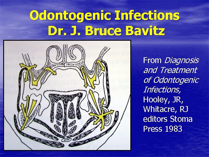 Odontogenic Infections Dr. J. Bruce Bavitz From Diagnosis and Treatment of Odontogenic Infections, Hooley,
