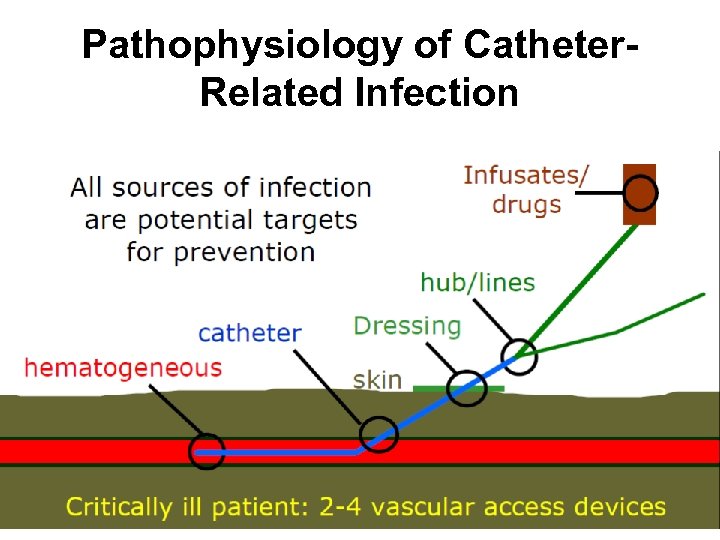 Pathophysiology of Catheter. Related Infection 