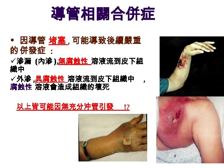 導管相關合併症 • 因導管 堵塞 , 可能導致後續嚴重 的 併發症 : ü 滲漏 (內滲 ), 無腐蝕性