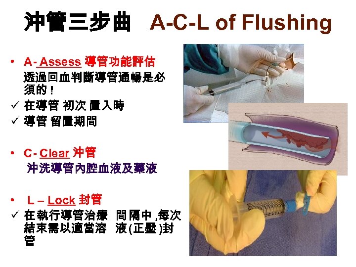 沖管三步曲 A-C-L of Flushing • A- Assess 導管功能評估 透過回血判斷導管通暢是必 須的 ! ü 在導管 初次