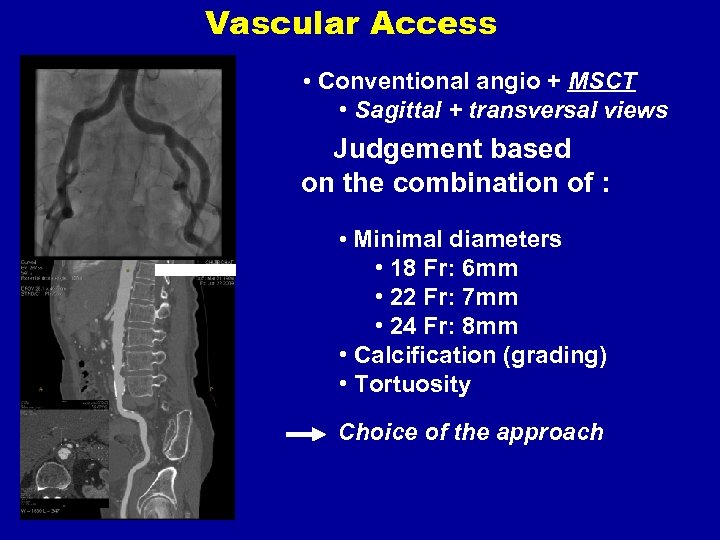 Vascular Access • Conventional angio + MSCT • Sagittal + transversal views Judgement based