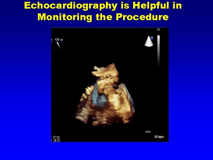 Echocardiography is Helpful in Monitoring the Procedure 