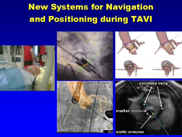 New Systems for Navigation and Positioning during TAVI 