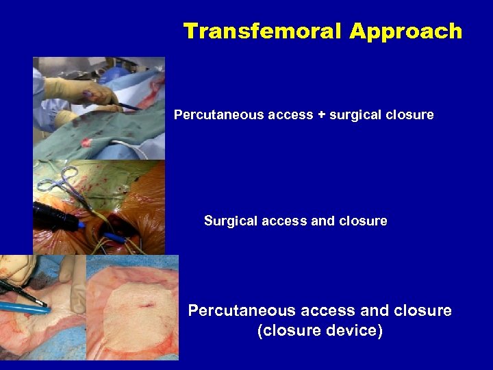 Transfemoral Approach Percutaneous access + surgical closure Surgical access and closure Percutaneous access and