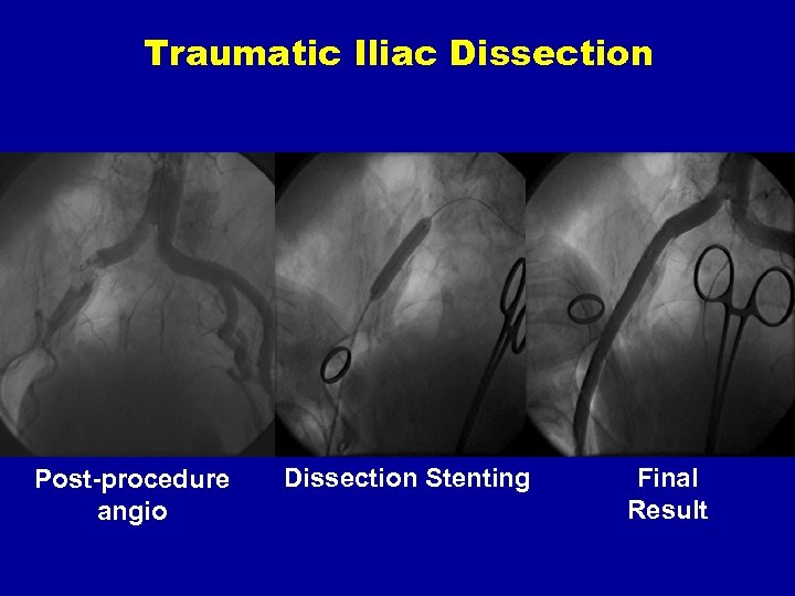 Traumatic Iliac Dissection Post-procedure angio Dissection Stenting Final Result 