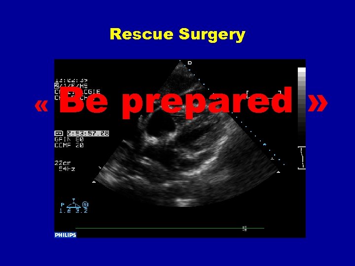 Rescue Surgery « Be prepared » 