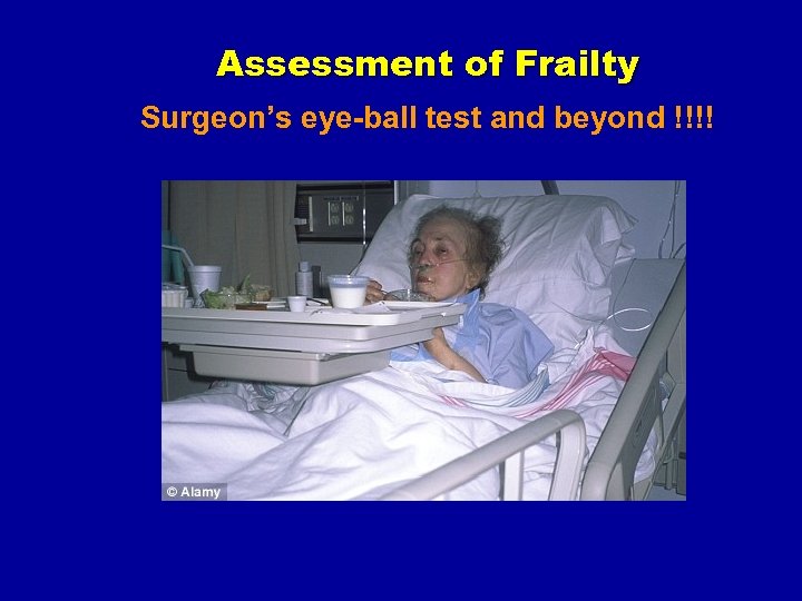 Assessment of Frailty Surgeon’s eye-ball test and beyond !!!! 