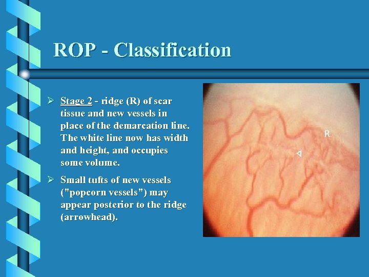 ROP - Classification Ø Stage 2 - ridge (R) of scar tissue and new