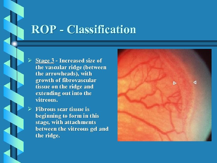 ROP - Classification Ø Stage 3 - Increased size of the vascular ridge (between