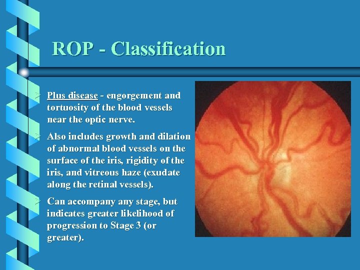 ROP - Classification Ø Plus disease - engorgement and tortuosity of the blood vessels