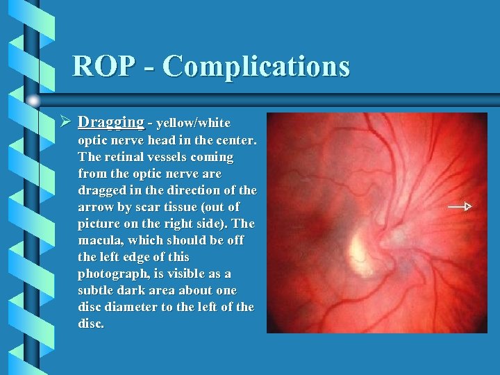 ROP - Complications Ø Dragging - yellow/white optic nerve head in the center. The