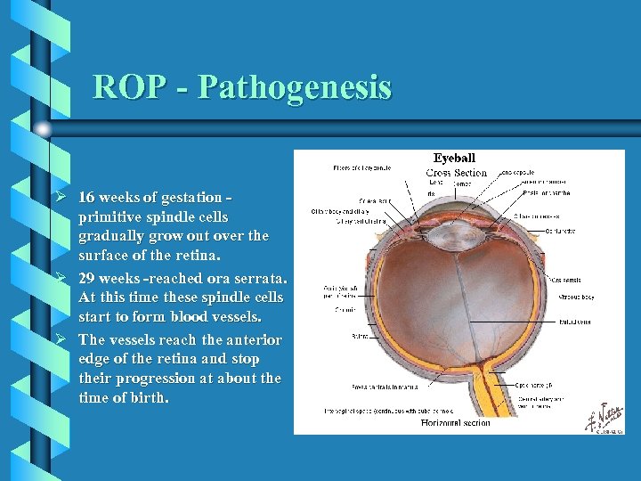 ROP - Pathogenesis Ø 16 weeks of gestation primitive spindle cells gradually grow out