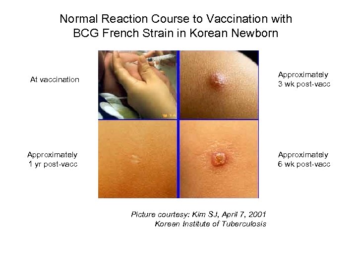 Normal Reaction Course to Vaccination with BCG French Strain in Korean Newborn At vaccination