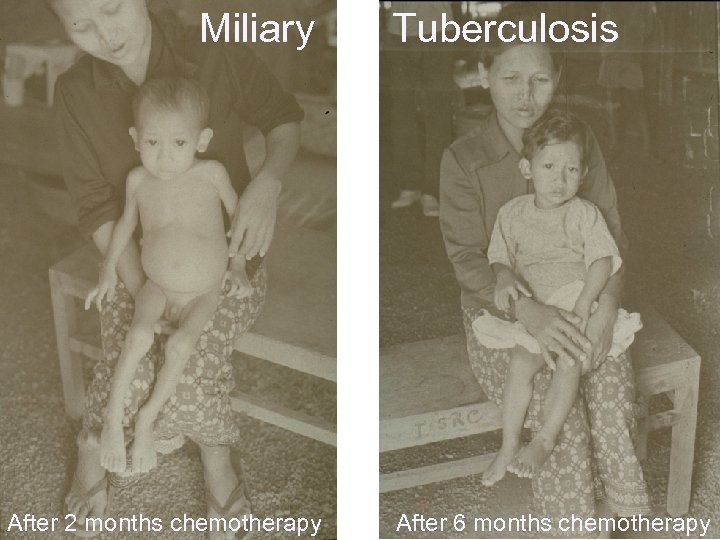 Miliary After 2 months chemotherapy Tuberculosis After 6 months chemotherapy 