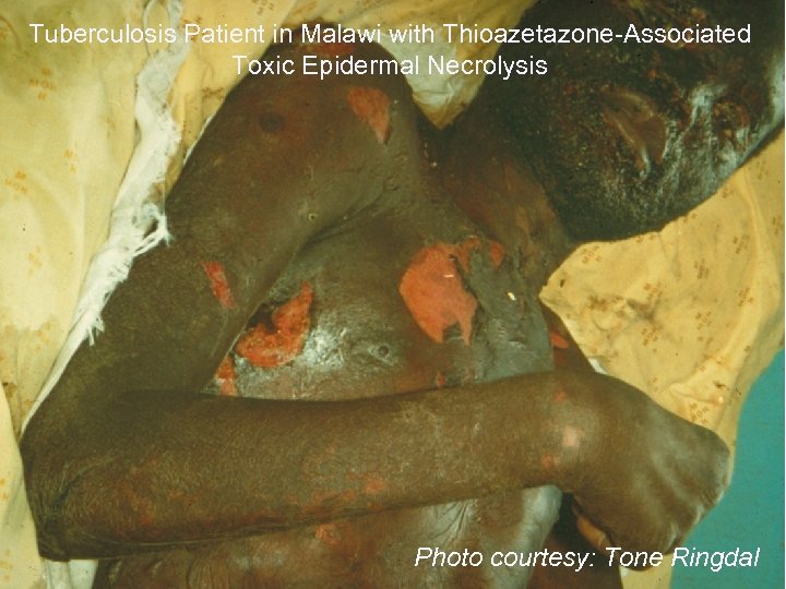 Tuberculosis Patient in Malawi with Thioazetazone-Associated Toxic Epidermal Necrolysis Photo courtesy: Tone Ringdal 