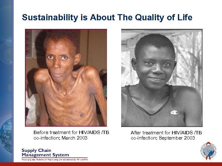 Sustainability is About The Quality of Life Before treatment for HIV/AIDS /TB co-infection; March