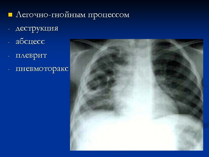 n - Легочно-гнойным процессом деструкция абсцесс плеврит пневмоторакс 