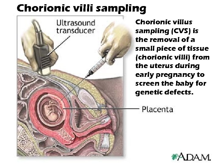 Chorionic villi sampling Chorionic villus sampling (CVS) is the removal of a small piece