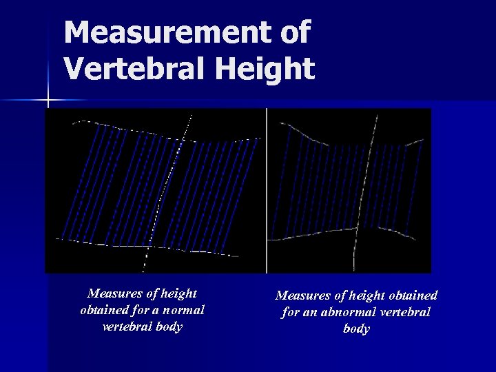 Measurement of Vertebral Height Measures of height obtained for a normal vertebral body Measures