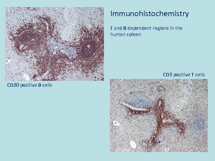 Immunohistochemistry T and B dependent regions in the human spleen CD 3 positive T